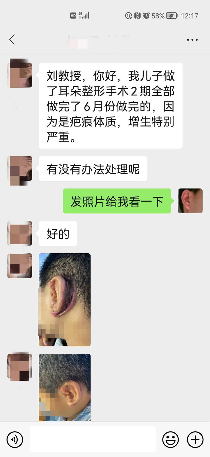 |再造的耳朵疤痕增生了怎么办?耳再造医生:根本的方法是不让疤痕出现