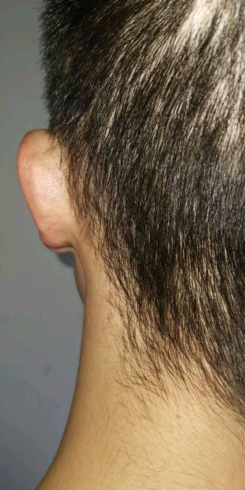 |再造的耳朵疤痕增生了怎么办?耳再造医生:根本的方法是不让疤痕出现