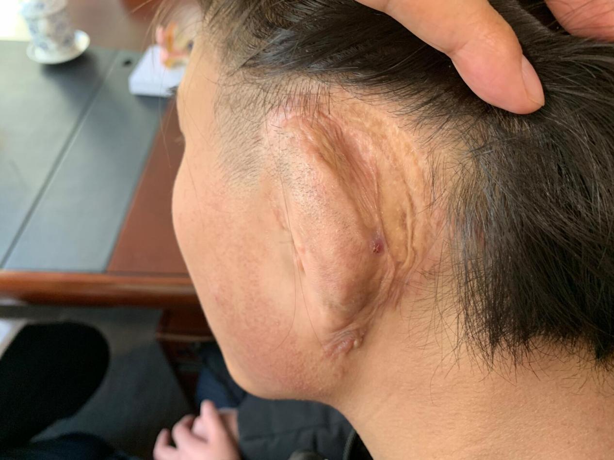 |再造的耳朵疤痕增生了怎么办?耳再造医生:根本的方法是不让疤痕出现