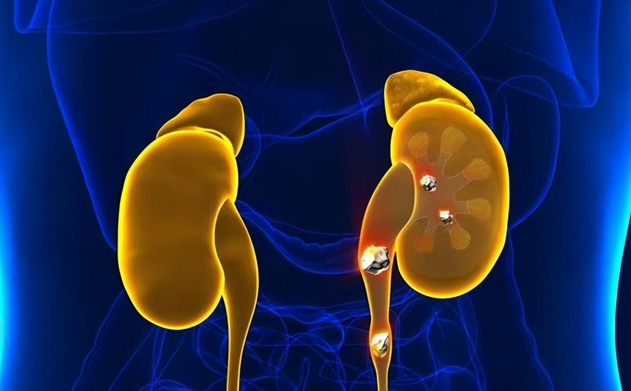 脑积水|40岁男子痛风发作，查出肾衰竭，提醒：2种食物加速恶化，管住嘴