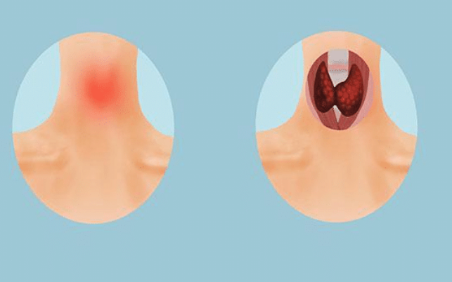 蔬果|我国2亿多人有甲状腺病?世卫组织:停食“3蔬果”,比戒碘还管用