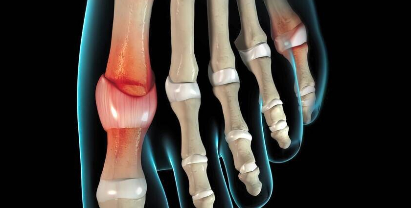 痛风|痛风了，长期喝苏打水能把尿酸降下来？医生来说清楚
