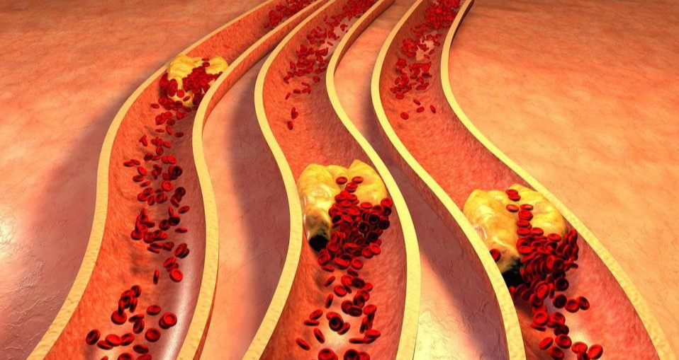不吃油、不吃肉，饮食清淡，为何血脂还高？望你早点搞清楚