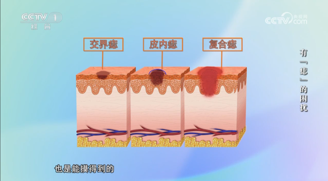 别再乱点痣了！痣出现这5种情况小心恶变，赶紧自查→