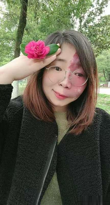 刘芳菲|我,因脸部有缺陷,找工作难,谈恋爱难,被嘲笑:将来谁会娶你