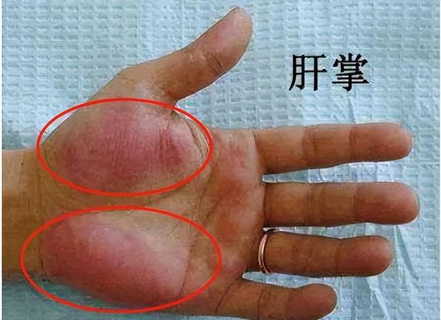 肝脏|肝脏硬化了,身体会有什么表现?肝不好,最怕你做这5件事