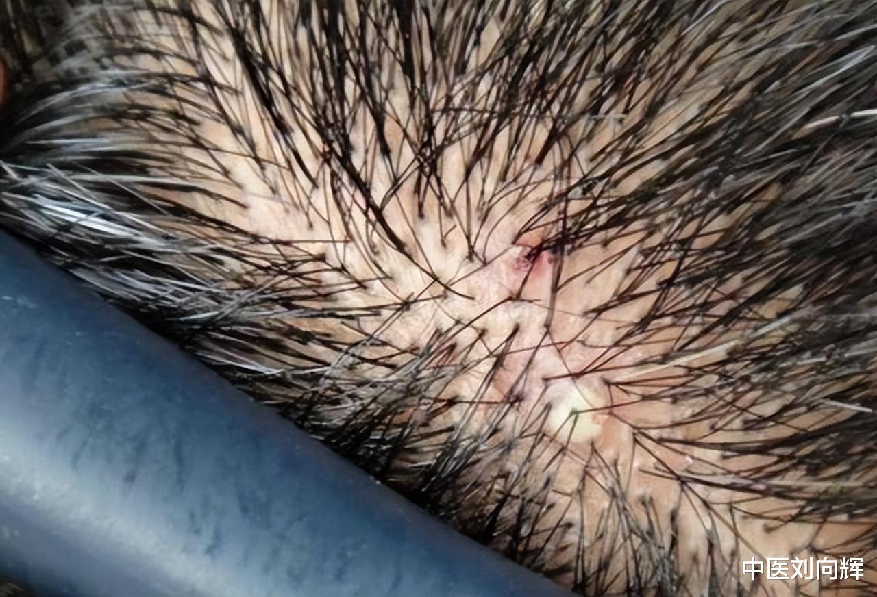 排便|头发里老是长疙瘩和脓包是怎么回事?中医告诉你答案