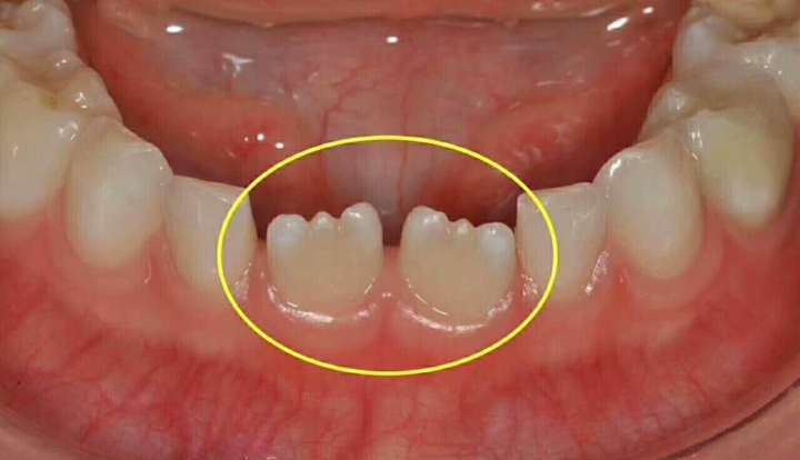 消化系统|历经艰辛防蛀牙，孩子却毁在换牙上
