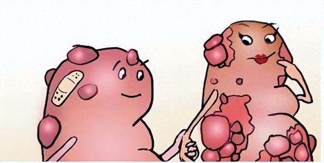 中医治疗肝囊肿，常用“行气逐水”方，气行痰瘀散，囊肿自己变小