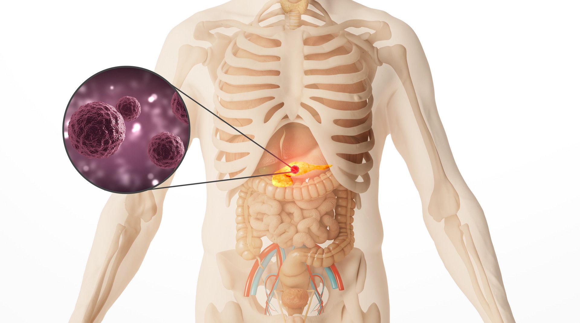 肠息肉|胰腺肿瘤规范化治疗有了新证据