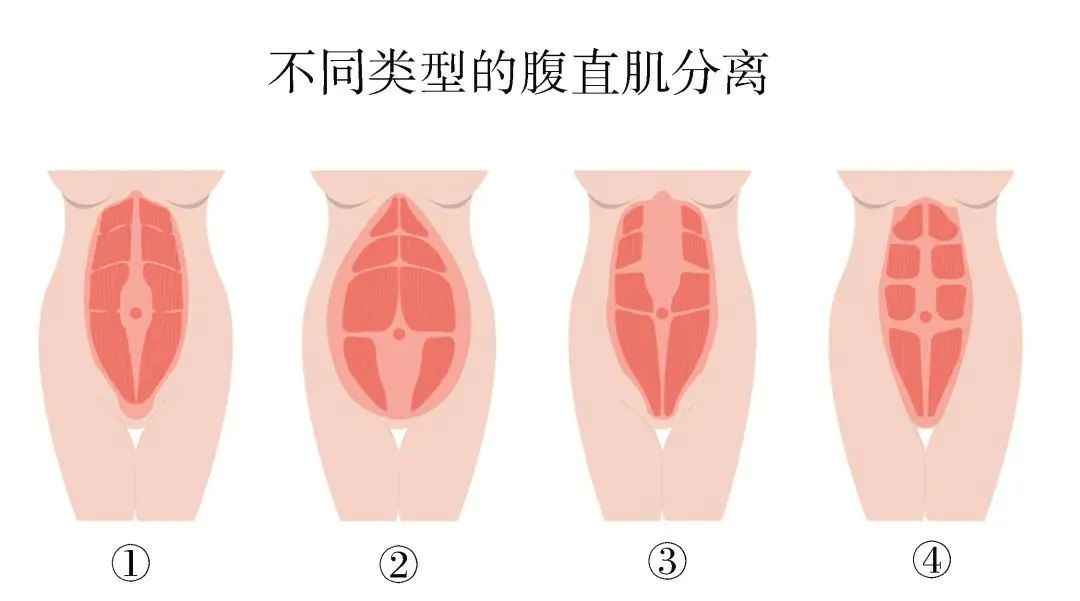 |被“掰开”的腹肌，腹直肌分离怎么办？3个动作让你自我检测
