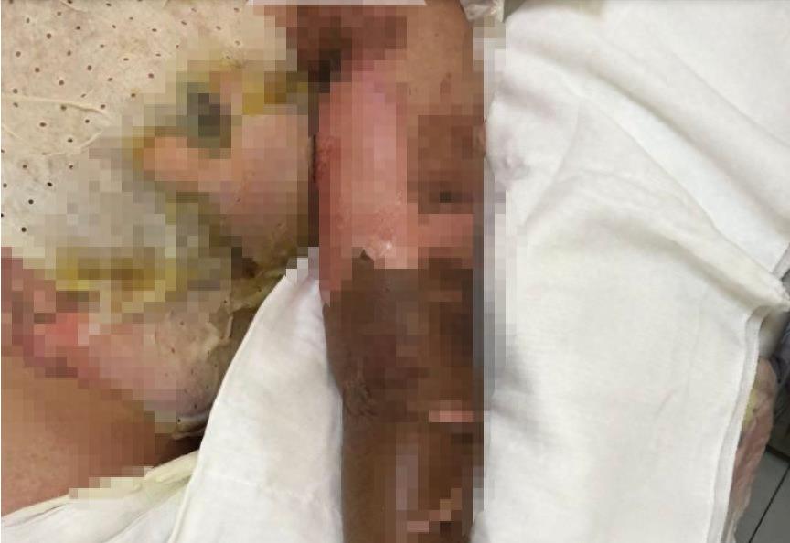 被男友泼滚烫热油,32岁女白领全身烧成炭,脓烂流黑水,只能绝望等死