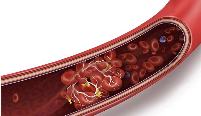 血栓来临，手脚先知！医生忠告：手脚有4种表现，或是血管堵了