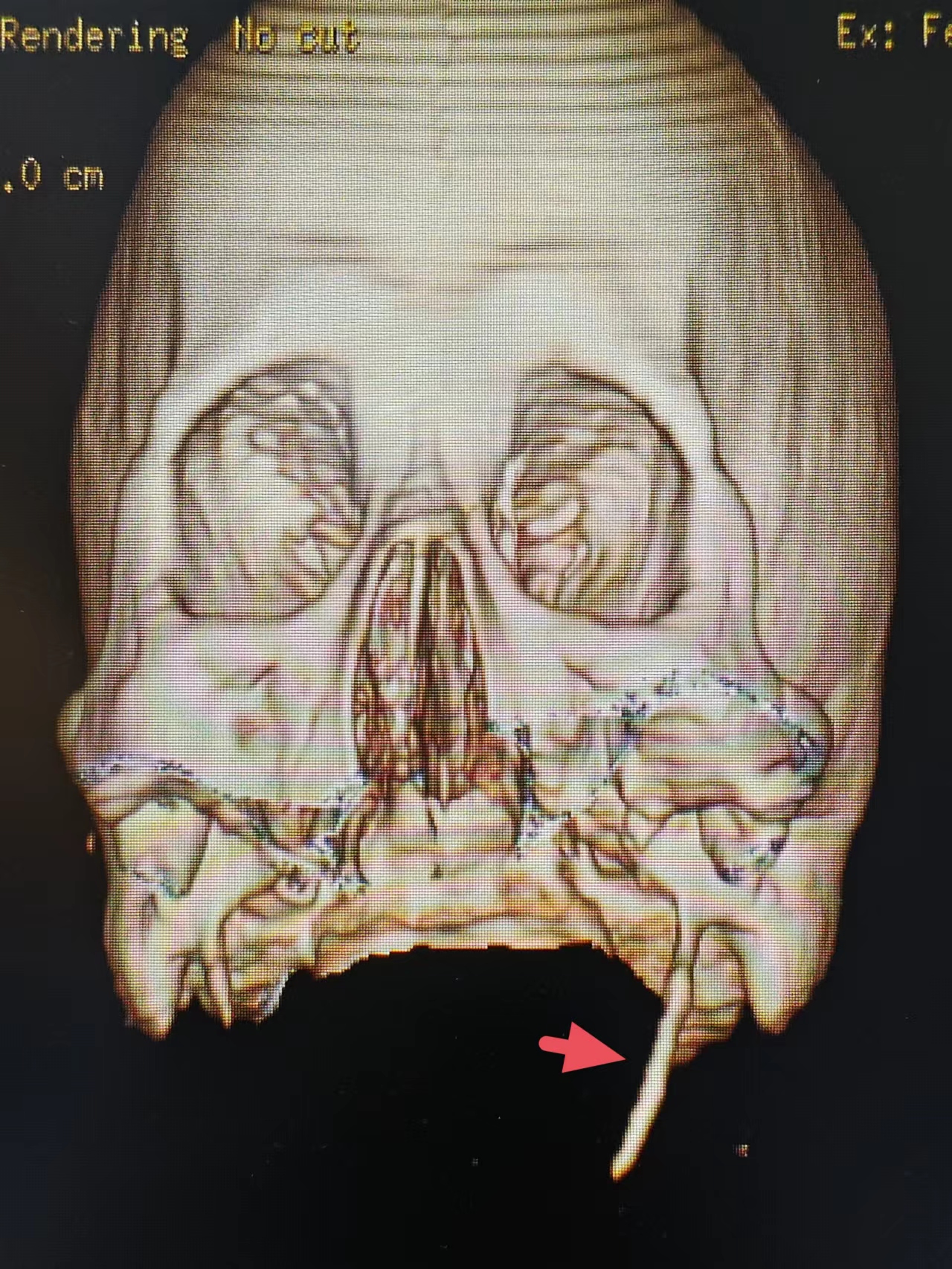 咽部异物感?警惕茎突综合征