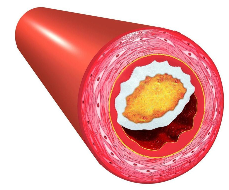 血栓|血栓来临并非“悄无声息”，提醒：手脚出现4个症状，别忽视