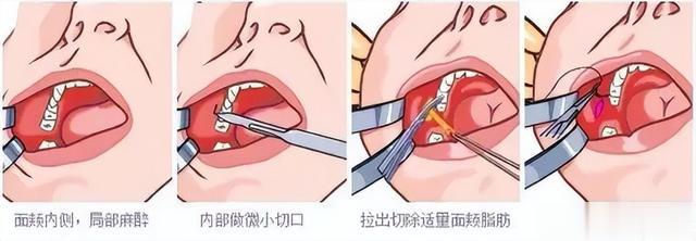 刘雯 高级如刘雯,也逃不过翻车的颧颊凹陷审美?