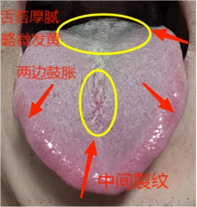 “敏感高”“一触即溃” 吃桂附地黄丸、右归丸没用，原因就在舌头