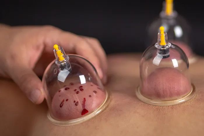 |拔罐颜色越深“毒”越多?