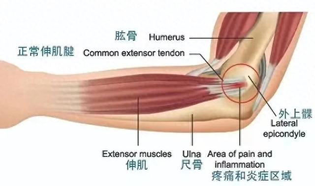 办公室“微运动”之，网球肘早诊断、早治疗