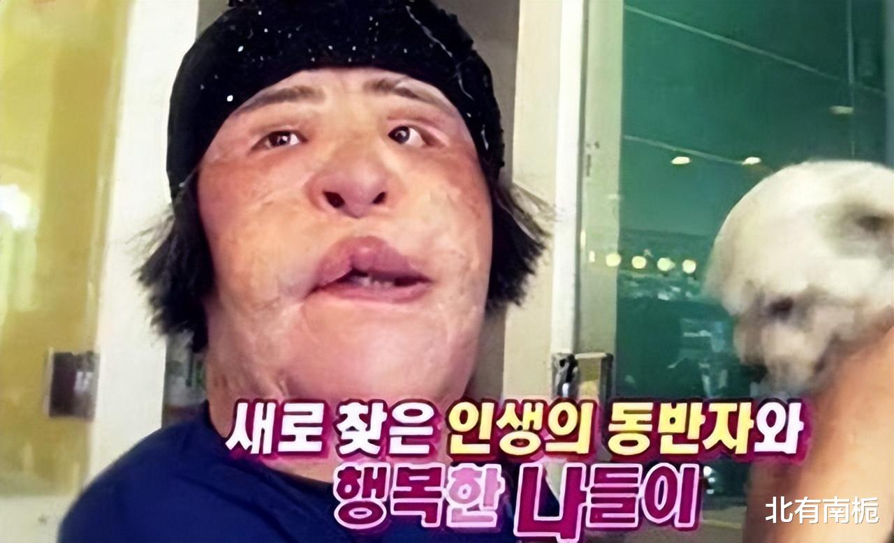 韩国女星整容上瘾注射大豆油,脸部取出8斤异物,最后孤独离世