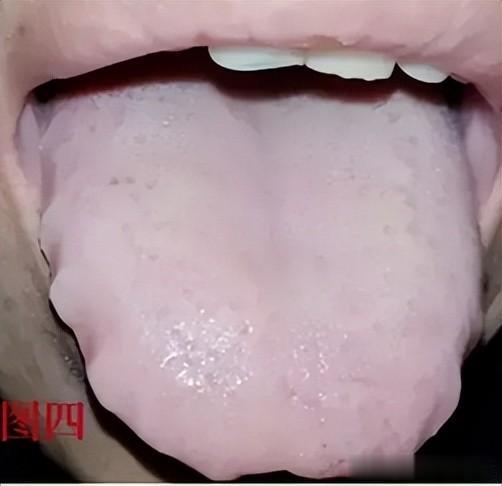 9种舌象9种体质,看镜子自查,学会了,不走弯路!