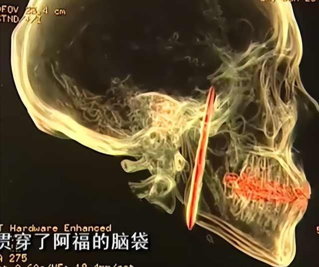 男子口臭骇人,每天刷牙数十遍都没用,检查发现颅内有10公分刀片