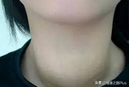 脖子上的小肉粒说明身体出了问题!