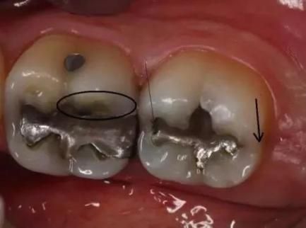 吸食冰毒为什么会牙齿脱落、烂掉！有没有解决的办法？