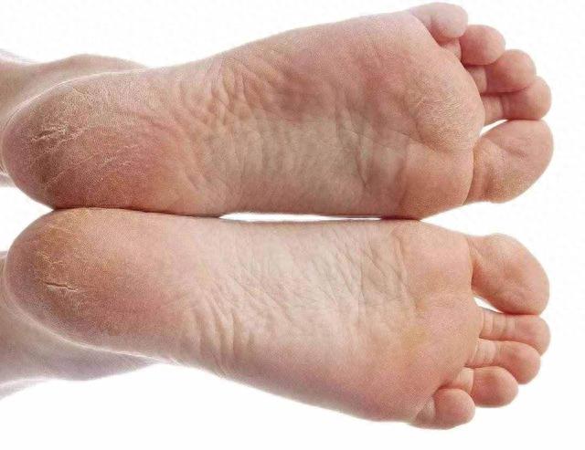 肝不好，脚先知？若双脚发出这4个信号，建议及早去做肝功检查