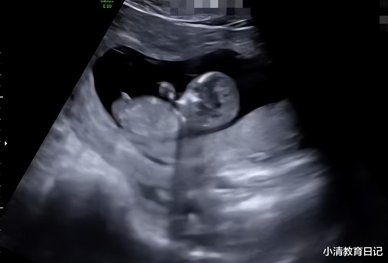 瞬息全宇宙|Selina首晒B超照疑曝光宝宝性别，她因患子宫肌瘤致孕肚格外大