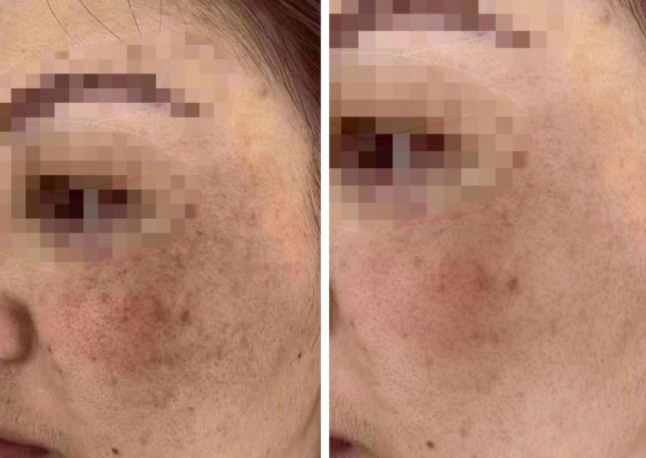 误区重重！黄褐斑患者用自己的脸做实验！