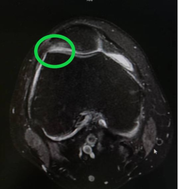 男子健身房突击锻炼，膝盖骨头被练“软”了