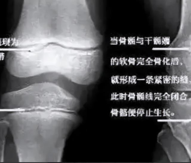 当年花16万断骨,只为长高7.2厘米的李亚诺,如今与后遗症为伴?