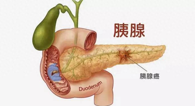 医生提醒：胰腺癌来临并非悄无声息，吃饭出现3种异常，尽早检查