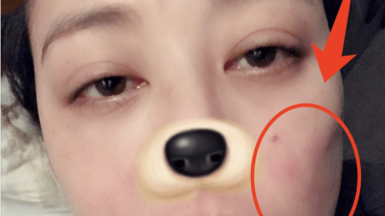 周海媚红斑狼疮病发照曝光！脸上多处红斑，眼神哀伤还隐含泪花