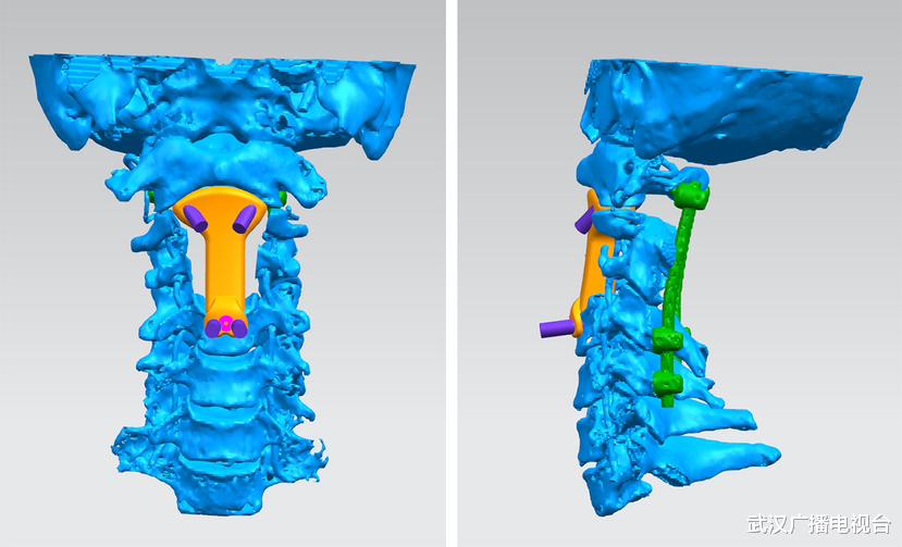 发病率仅为1/100万！立“椎”之地，协和专家精准拆除颈髓肿瘤“起爆器”