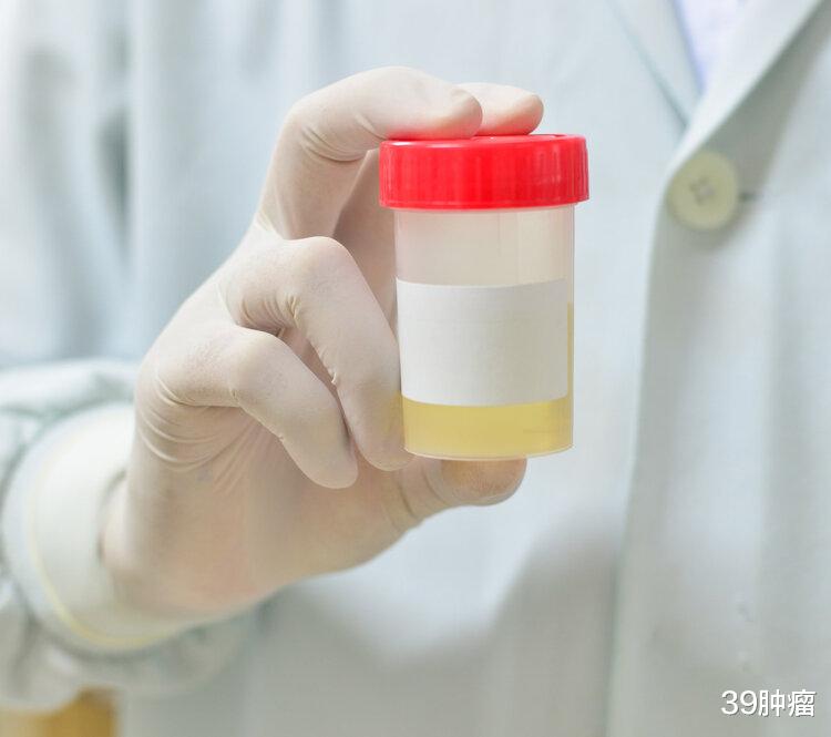 疾病|排尿很黄、还有异味?身体向你暗示的这2件事,可能与疾病有关