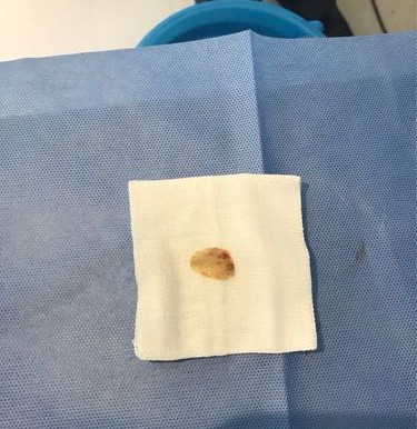 橡胶厂工人咳血,误诊肺癌化疗病情恶化,纤支镜一做医生怒了!