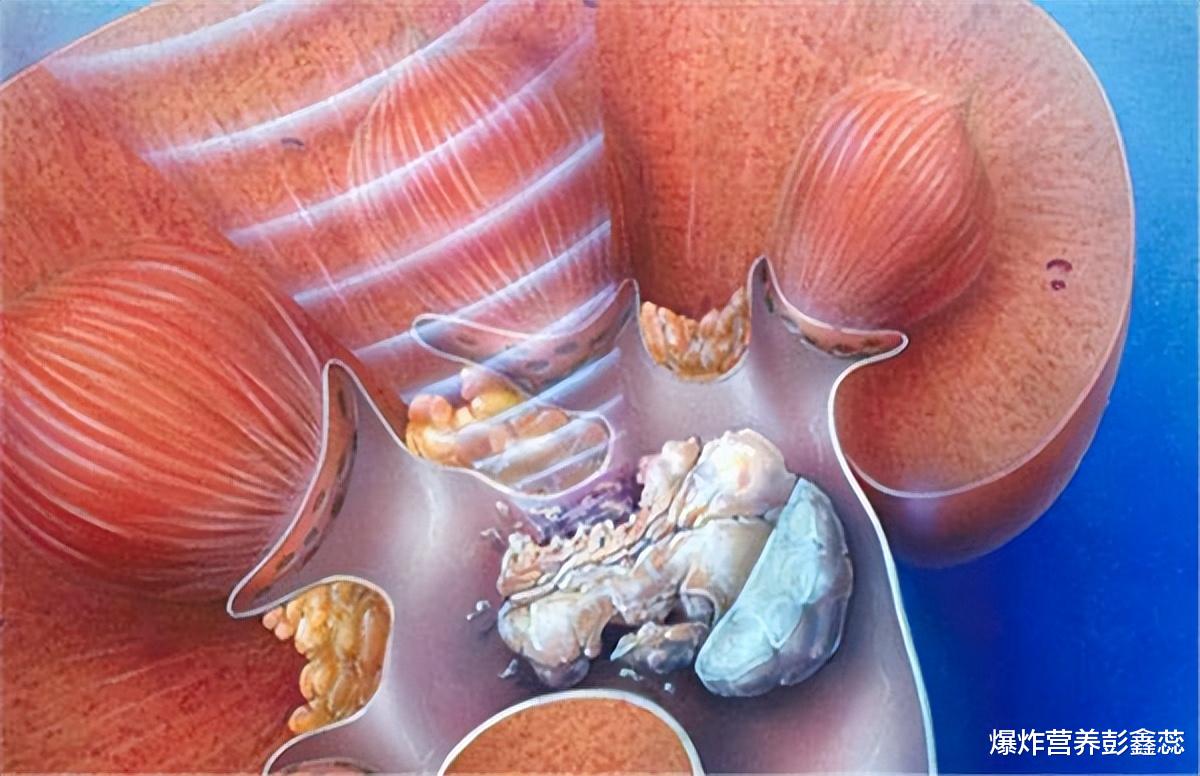 体内有结石，吃鸡内金就能排石吗？真正有效的办法是什么？