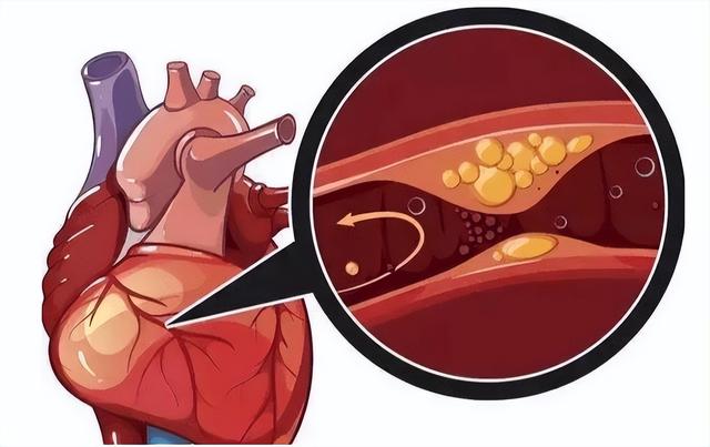 尿毒症|36岁女子,深夜心梗离世,提醒:一种水喝太多,血液会粘如粥