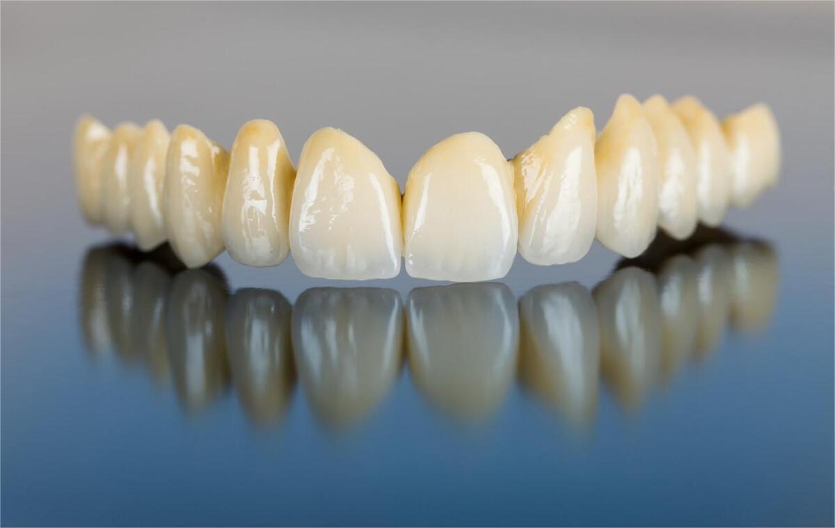 全瓷牙与烤瓷牙:如何做出明智选择? - 健康资讯(主打网)