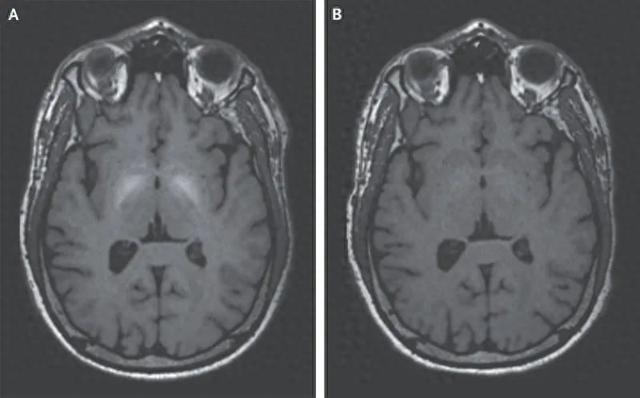 诊断帕金森病为什么要问职业史？（锰中毒）