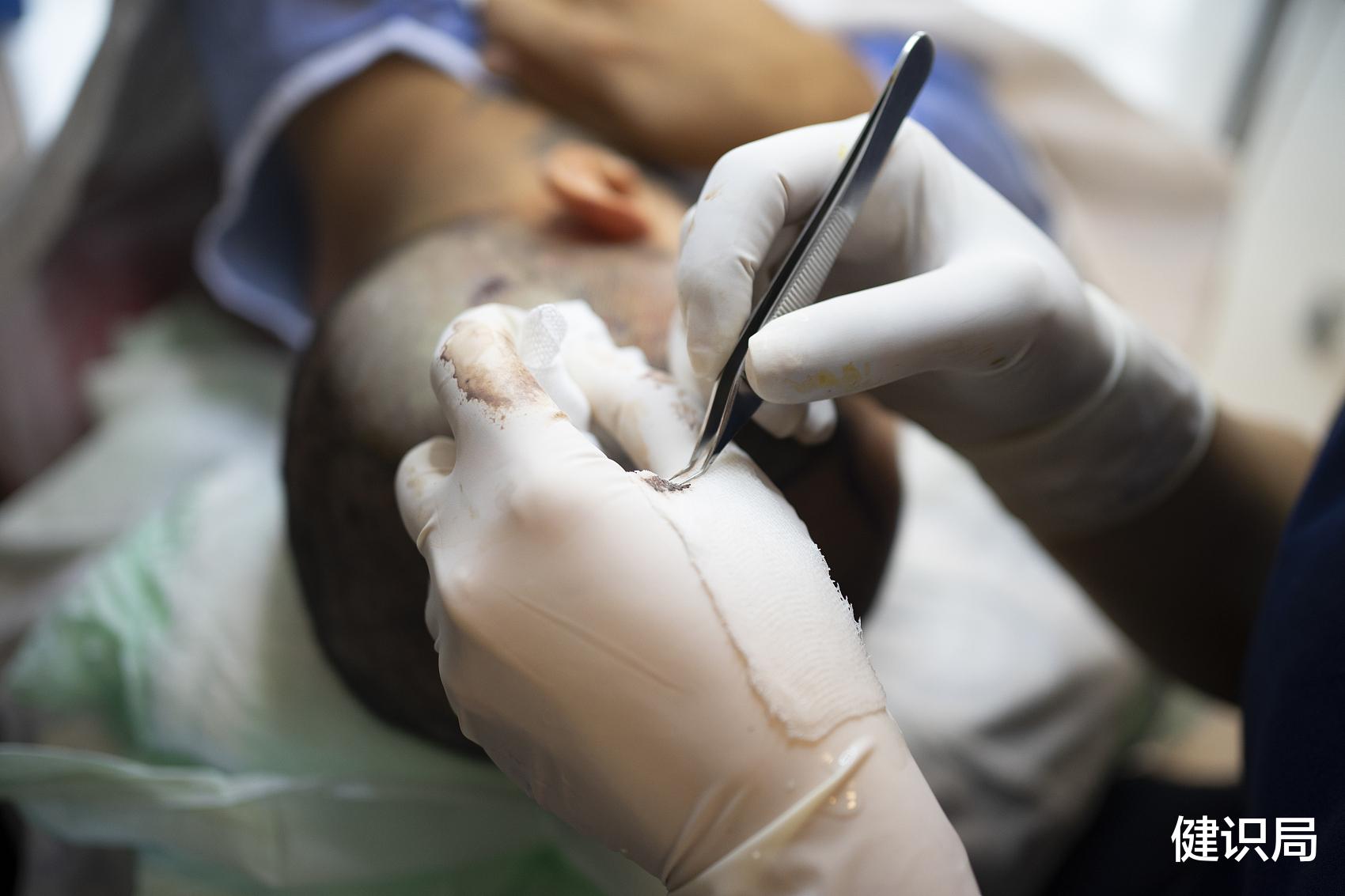 腹泻|没人在乎脱发了，植发企业就该焦虑了