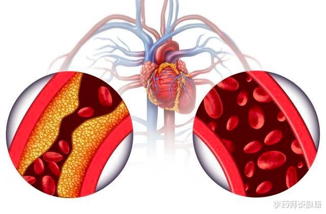 高血压|35岁血压血脂都升高，有家族史，不吃药如何保护心血管？