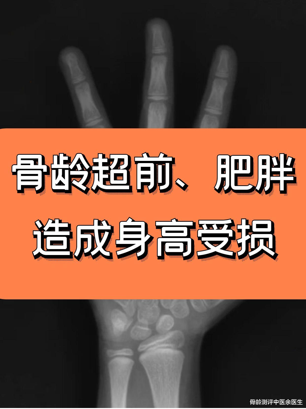 运动|骨龄超前、肥胖造成身高受损