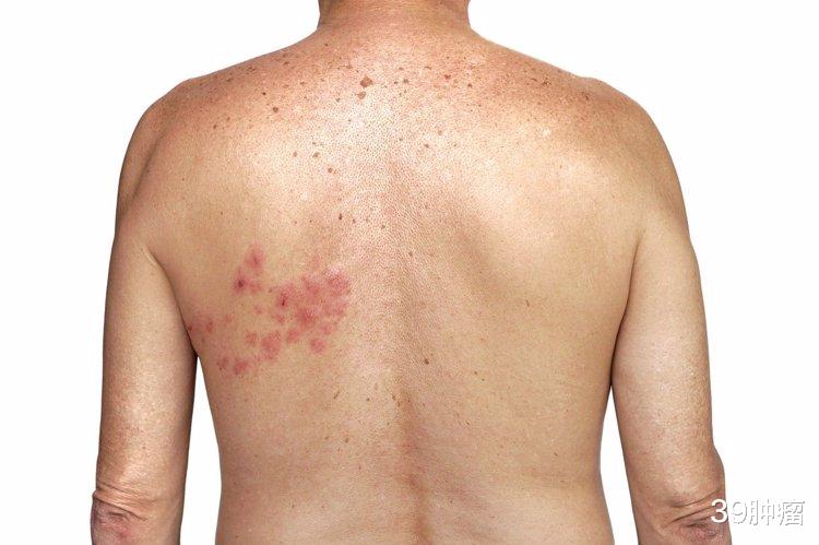 带状疱疹|有一种剧痛叫“带状疱疹”,用什么药好得快?教你3招对付它