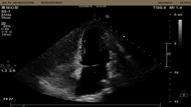 你了解右心声学造影吗？