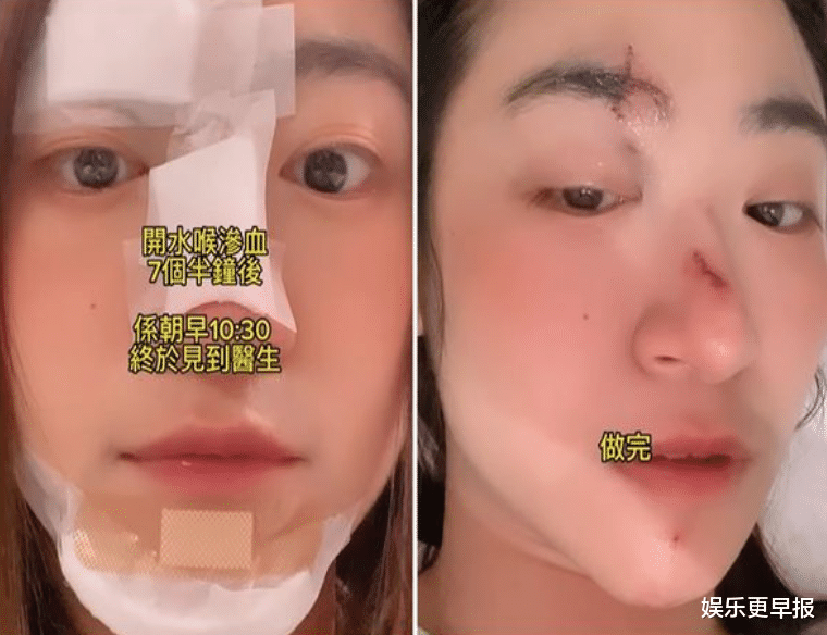 赵露思|黄紫恩晕倒「90度砸下」正脸撞水泥地!血淋淋伤照曝光:捡回一条命