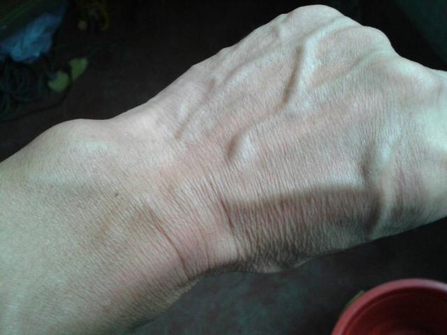 肝脏发出预警时，“手上”会有5个信号，有一个，建议尽快做肝CT