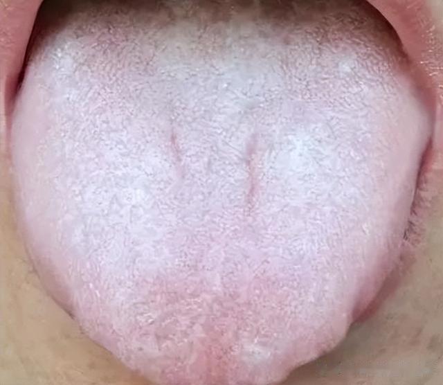 疾病|舌头中间有裂纹,边缘有齿痕等,是大病征兆?现在知道还不晚!